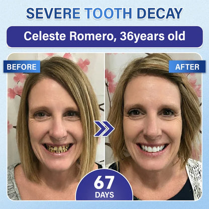 Ceoerty® Tooth & Gum Care Fast-Dissolving Microneedle Patch✨ (𝟓-𝐢𝐧-𝟏 💎 𝐑𝐞𝐛𝐮𝐢𝐥𝐝 𝐄𝐧𝐚𝐦𝐞𝐥 & 𝐃𝐞𝐧𝐭𝐢𝐧 • 𝐒𝐭𝐫𝐞𝐧𝐠𝐭𝐡𝐞𝐧 𝐆𝐮𝐦𝐬 • 𝐄𝐫𝐚𝐝𝐢𝐜𝐚𝐭𝐞 𝐓𝐚𝐫𝐭𝐚𝐫 & 𝐎𝐝𝐨𝐫 • 𝐖𝐡𝐢𝐭𝐞𝐧𝐢𝐧𝐠 • 𝐒𝐭𝐨𝐩 𝐓𝐨𝐨𝐭𝐡 𝐒𝐞𝐧𝐬𝐢𝐭𝐢𝐯𝐢𝐭𝐲)