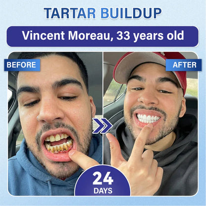 Ceoerty® Tooth & Gum Care Fast-Dissolving Microneedle Patch✨ (𝟓-𝐢𝐧-𝟏 💎 𝐑𝐞𝐛𝐮𝐢𝐥𝐝 𝐄𝐧𝐚𝐦𝐞𝐥 & 𝐃𝐞𝐧𝐭𝐢𝐧 • 𝐒𝐭𝐫𝐞𝐧𝐠𝐭𝐡𝐞𝐧 𝐆𝐮𝐦𝐬 • 𝐄𝐫𝐚𝐝𝐢𝐜𝐚𝐭𝐞 𝐓𝐚𝐫𝐭𝐚𝐫 & 𝐎𝐝𝐨𝐫 • 𝐖𝐡𝐢𝐭𝐞𝐧𝐢𝐧𝐠 • 𝐒𝐭𝐨𝐩 𝐓𝐨𝐨𝐭𝐡 𝐒𝐞𝐧𝐬𝐢𝐭𝐢𝐯𝐢𝐭𝐲)